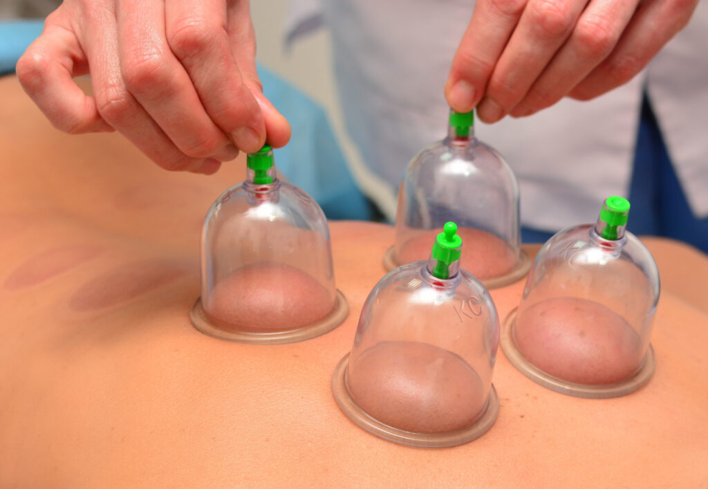 Picture of Cupping Therapy @ Bodies Kneaded Massage Spa South Beach Miami Since 1996 www.BodiesKneaded.com 305.535.2424