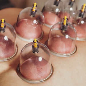 picture of a person getting cupping @ Bodies Kneaded Massage Spa South Beach Miami Since 1996 www.BodiesKneaded.com 305.535.2424